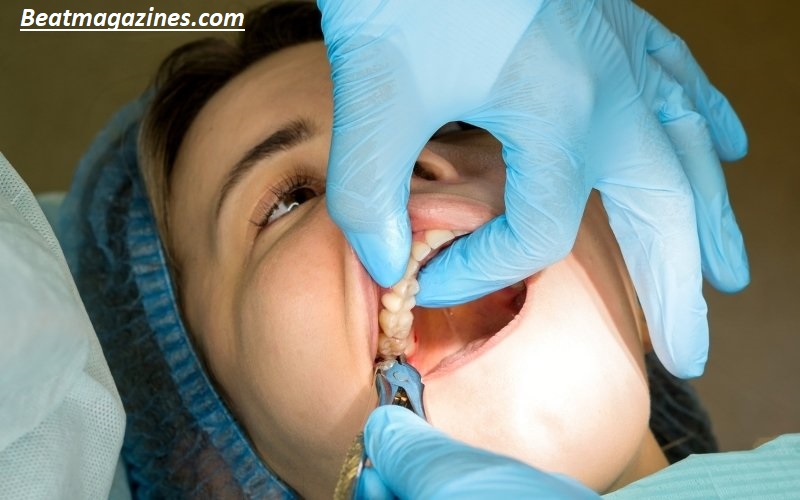Why Experts Now Say Not to Remove Your Wisdom Teeth? Surprising Facts