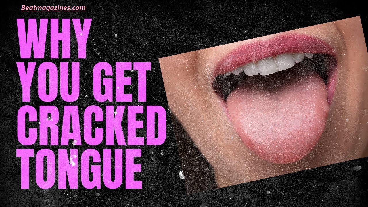 Why Does My Tongue Have Cracks? 7 Surprising Causes You Shouldn’t Ignore