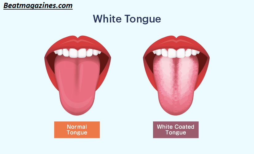 Why Is My Tongue White? The Hidden Health Warning Signs Explained